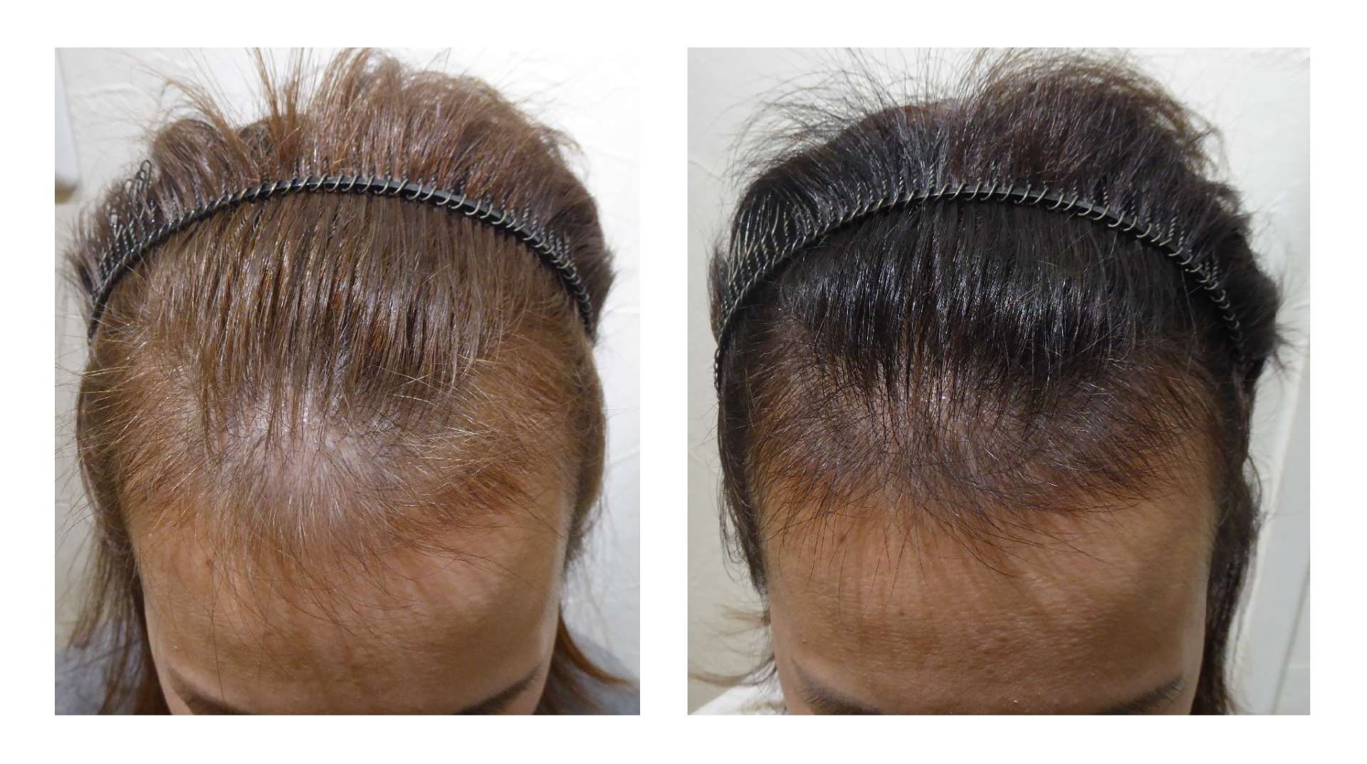 AGA・姫路発毛サロン　40代女性【髪の毛が伸びてこない・・・】