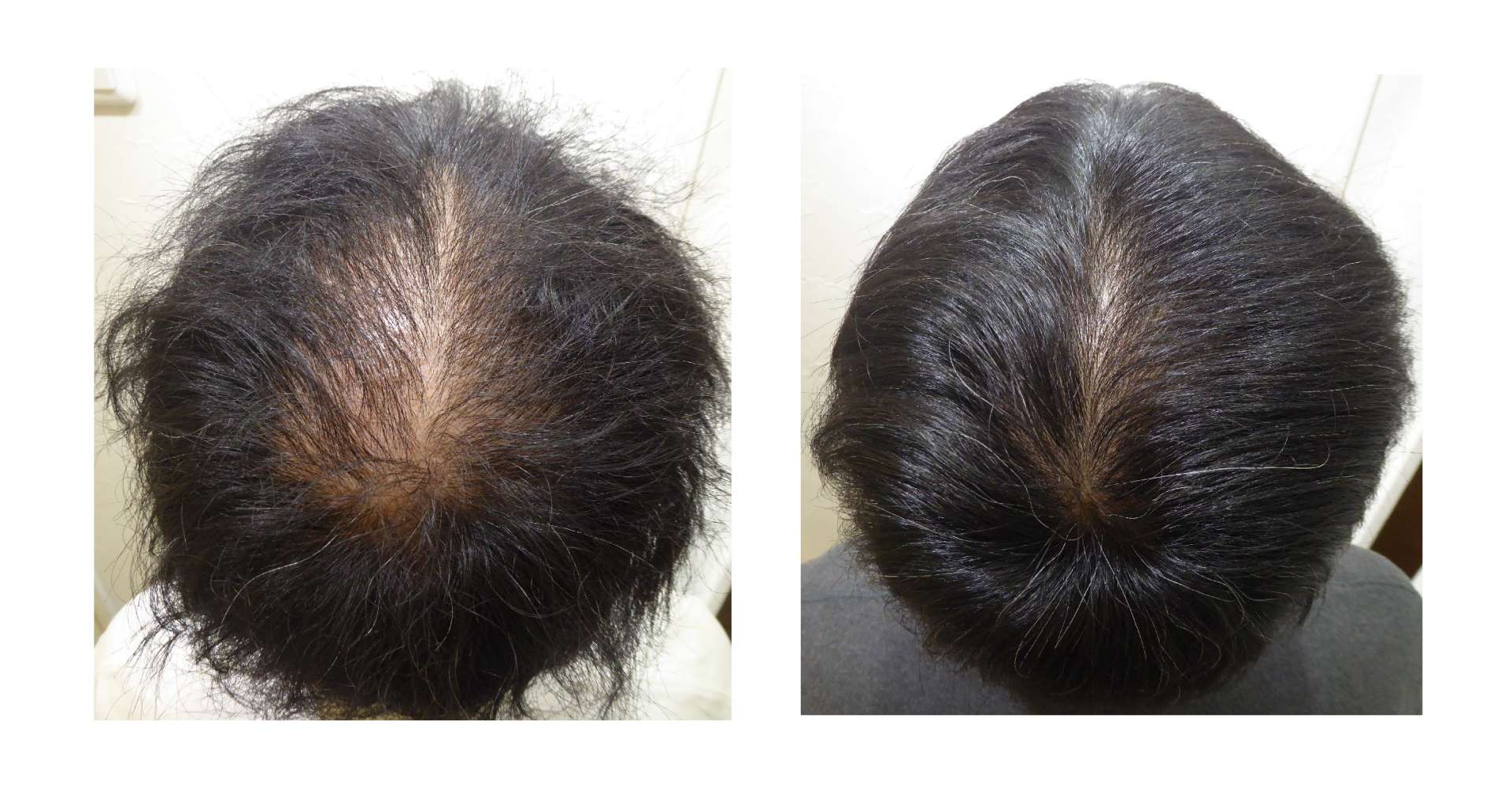 AGA・姫路発毛サロン　2025【スーパースカルプ大会エントリー症例】№1