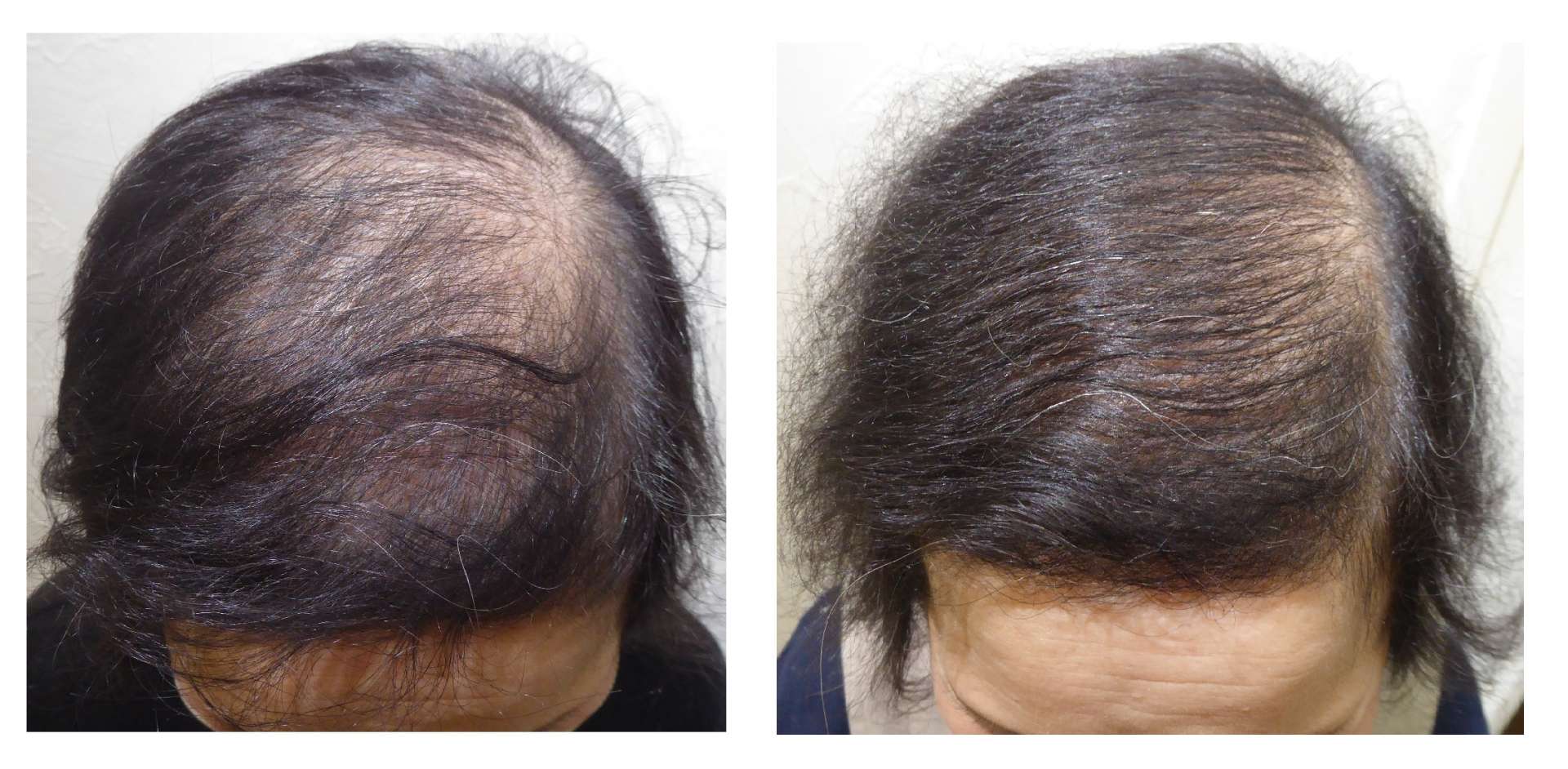 AGA・姫路発毛サロン　2025【スーパースカルプ大会エントリー症例】№2