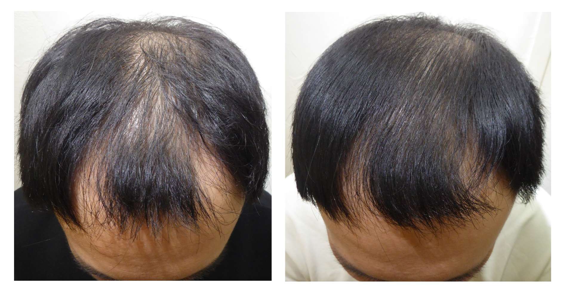 AGA・姫路発毛サロン　2025【スーパースカルプ大会エントリー症例】№5