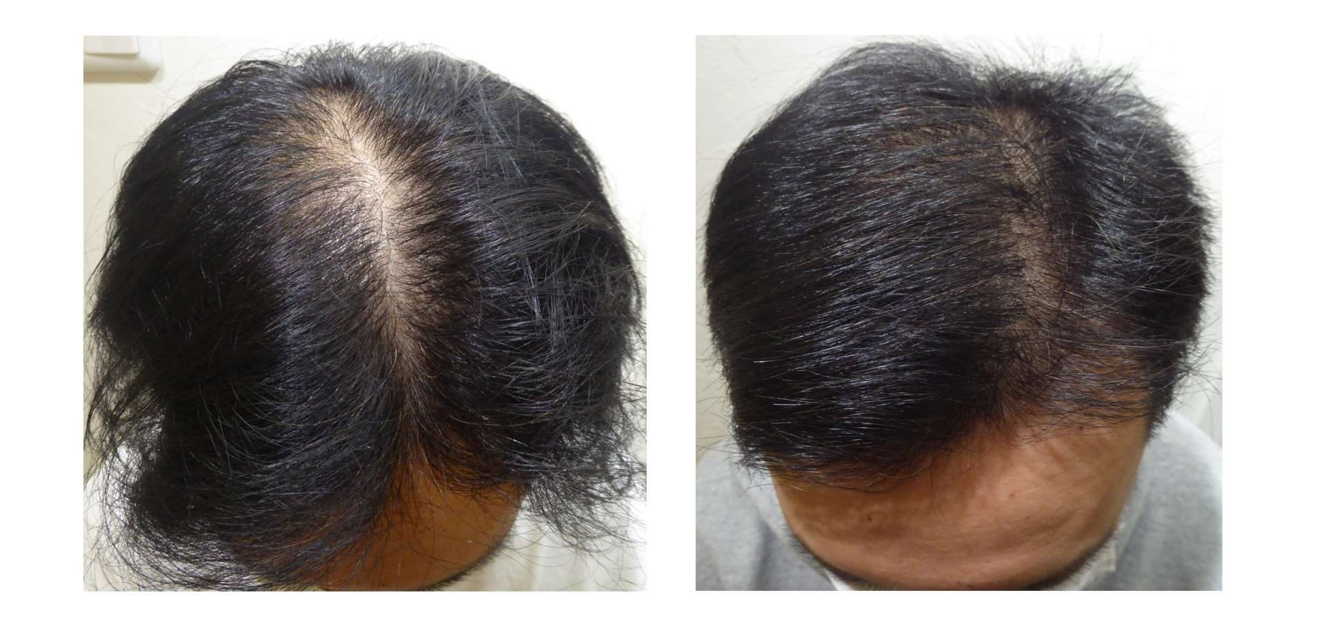 AGA・姫路発毛サロン　2025【スーパースカルプ大会エントリー症例】№6