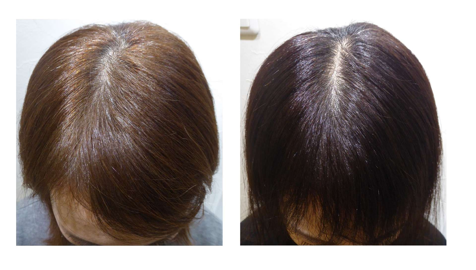 AGA・姫路発毛サロン　40代女性【前髪ずっと伸びない・・・】