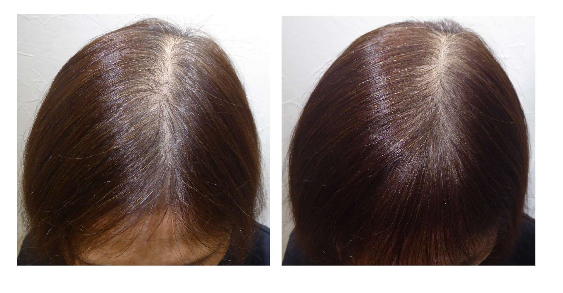 AGA・姫路発毛サロン　40代女性【頭皮が気になる・・・】