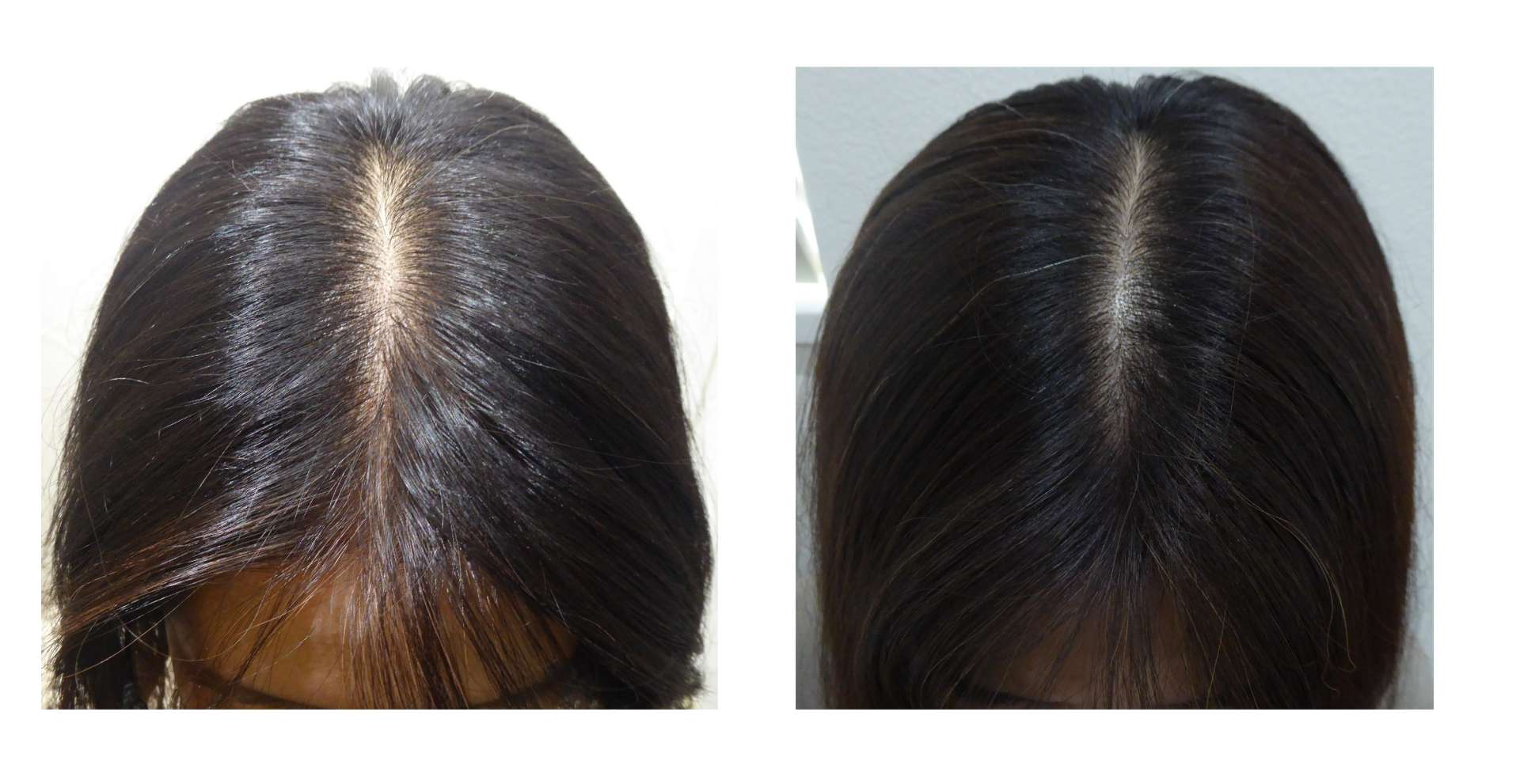 AGA・姫路発毛サロン　発毛は“内側”で決まる！